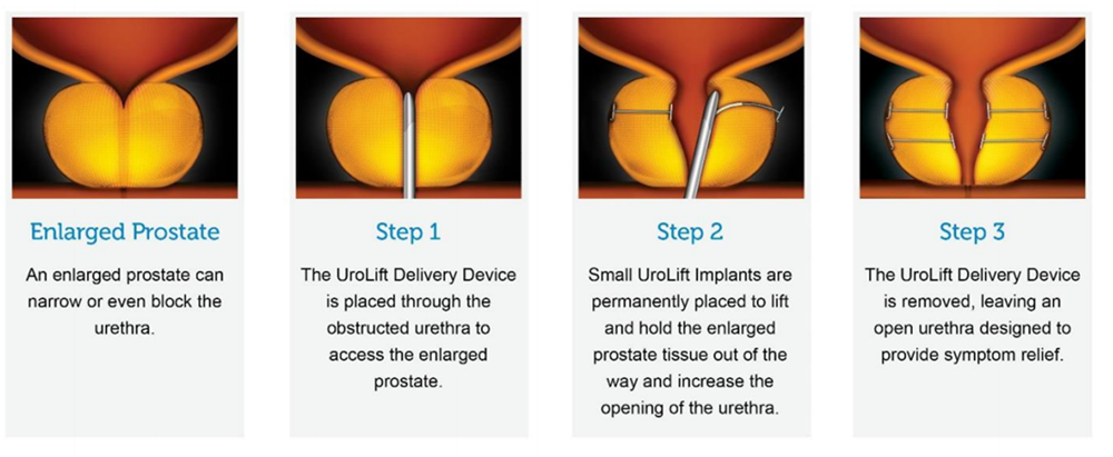 urolift description